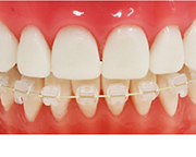 矯正器具が目立たないものに