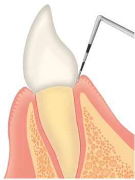 歯周病は慢性疾患、生活習慣病です！まずは診査・診断を！