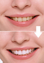 オフィスホワイトニング